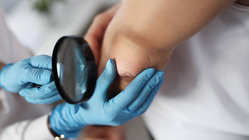 Pulmo Sleep Centar Eliksir | Sistemska skleroza (sklerodermija) – rana dijagnostika i praćenje